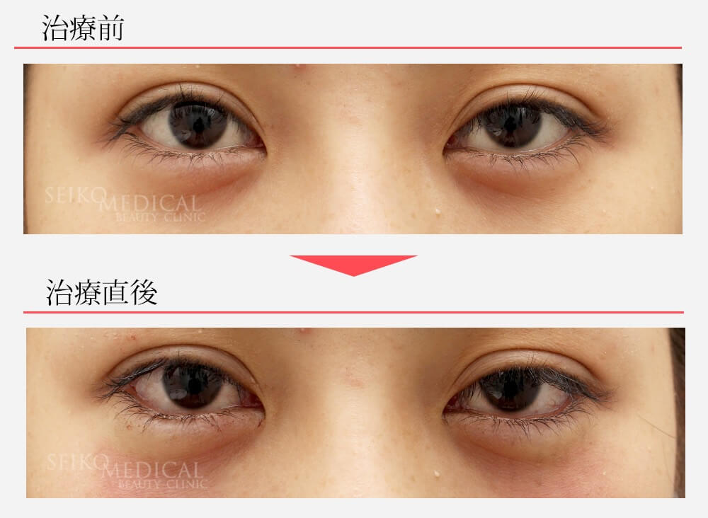 垂れ目形成術(下眼瞼下制術、グラマラスライン）の直後の症例解説