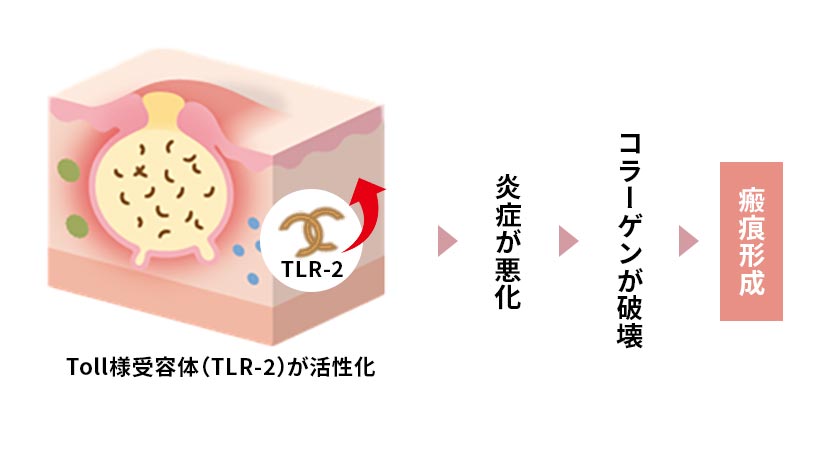 ニキビ痕（瘢痕）ができる仕組みと、その原因