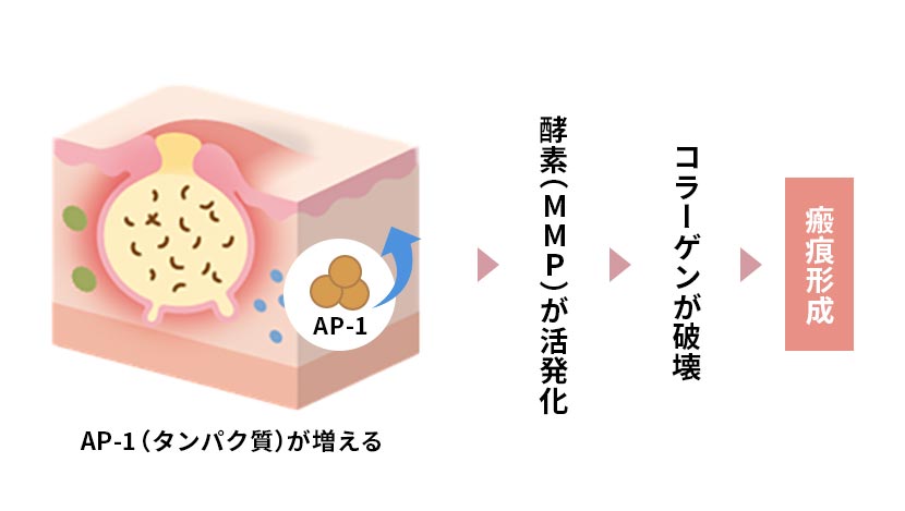 コラーゲンを壊す酵素が活性化する