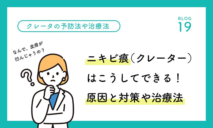 ニキビ痕（クレーター）はこうしてできる！原因と対策や治療法