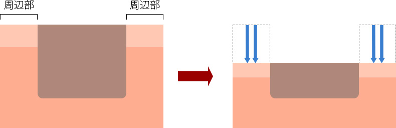 瘢痕周囲の引き締めにより平坦化