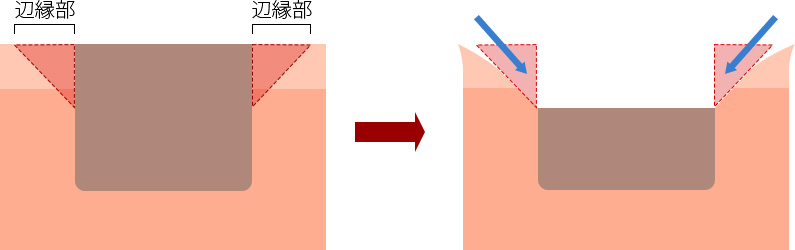 陥凹部辺縁を削りスムースにする