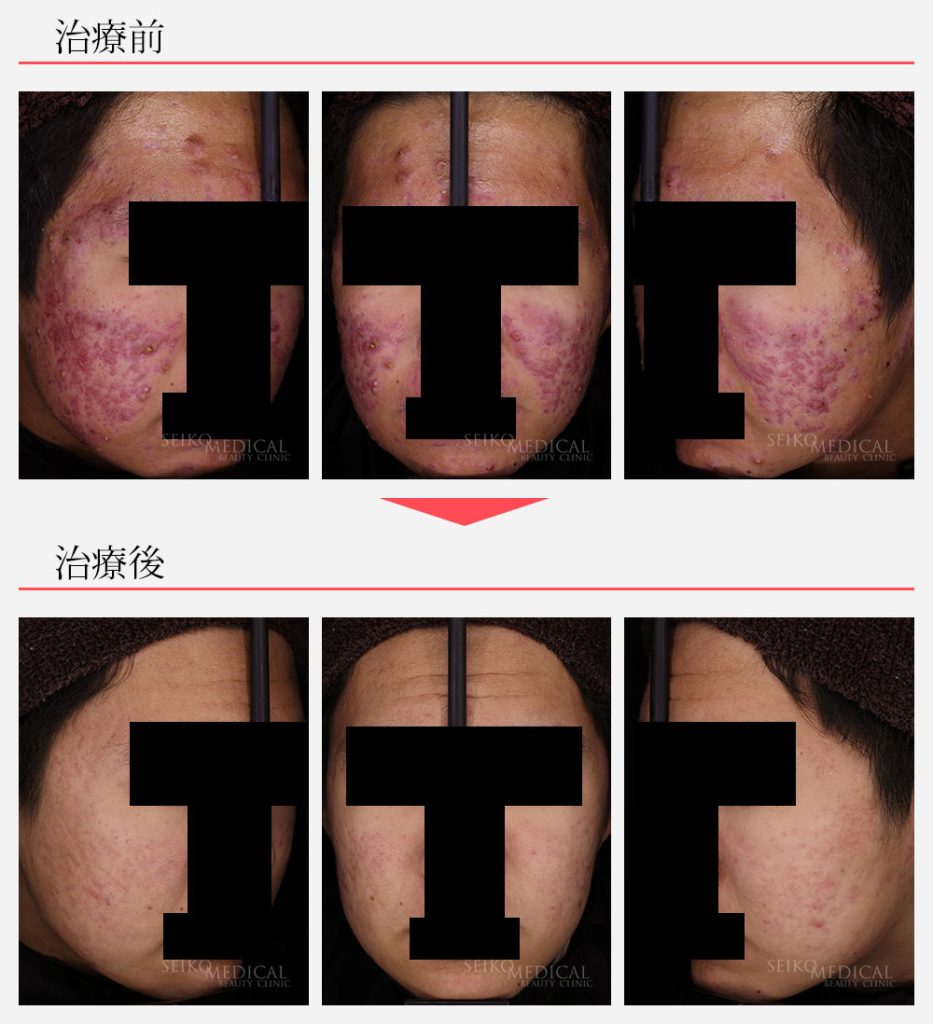 ニキビ症例07　学生特別治療