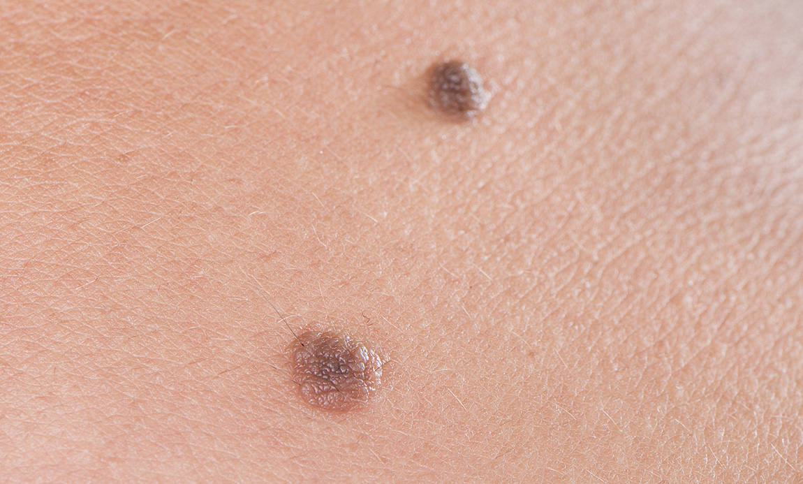 ほくろ