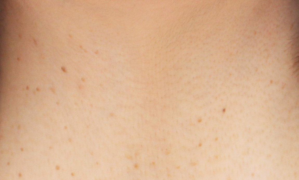 アクロコルドン