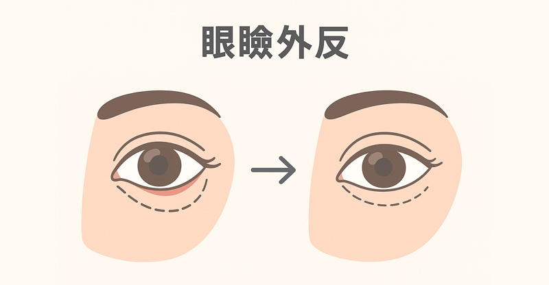 眼瞼外反症