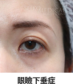 眼瞼下垂症