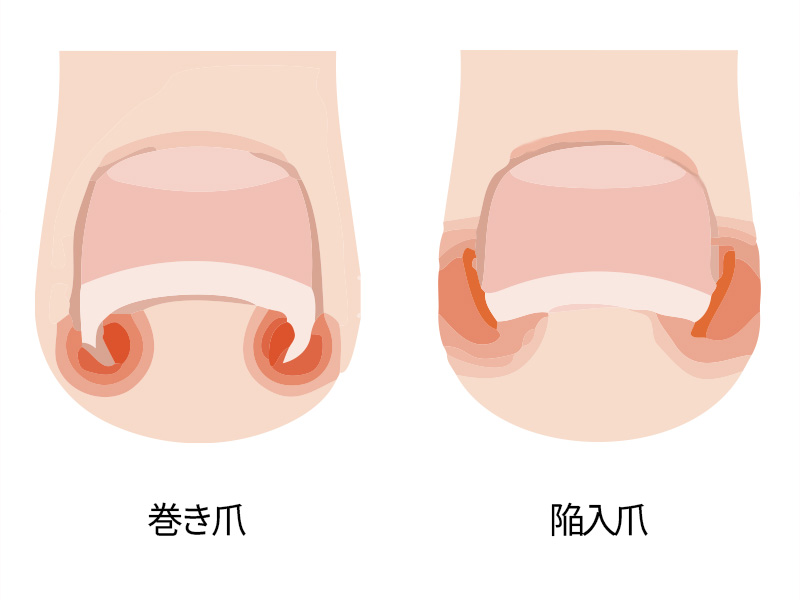 巻き爪と陥入爪