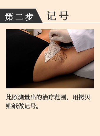 记号 比照测量出的治疗范围，用拷贝贴纸做记号。