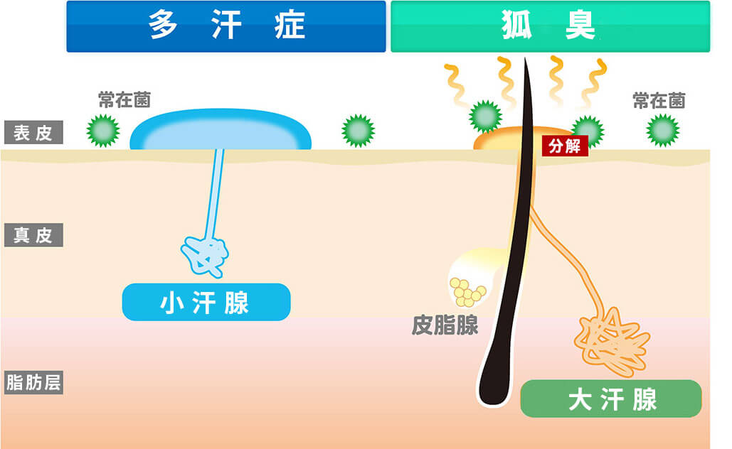 多汗症とワキガの図
