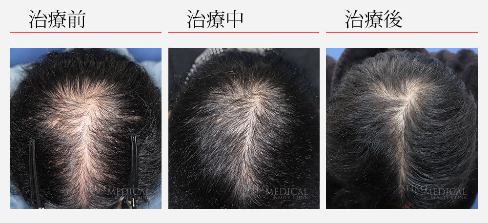 AGA（男性型脱毛症）に対する治療に関して　「薄毛は克服できる！」