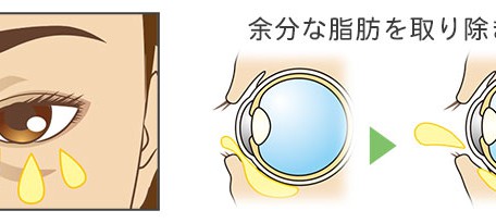 下眼瞼脂肪除去の治療方法