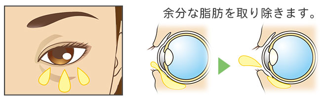 下眼瞼脂肪除去の治療方法