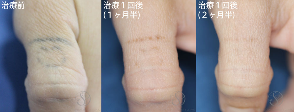 タトゥー除去症例写真のご紹介 セイコメディカルビューティクリニック 鹿児島 福岡