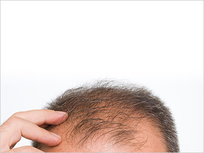 AGA（男性型脱毛症）治療 症例のご紹介