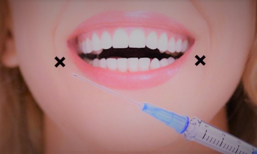 笑った時に口角がキュッ メスを使わず注射器で注入するため、傷跡や 腫れの心配がなく注入直後から効果を実感 できる治療です。