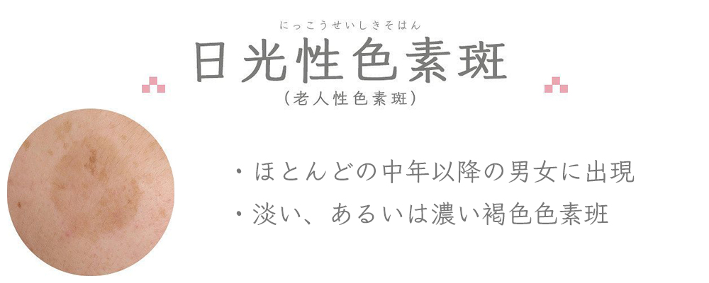 日光性色素班：ほとんどの中年以降の男女に出現／淡い、あるいは濃い褐色色素班