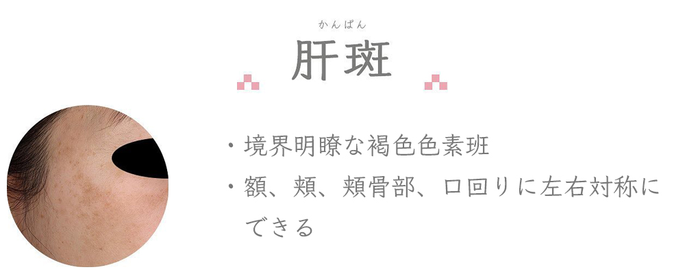 肝斑：境界明瞭な褐色色素班／額、頬、頬骨部、口回りに左右対称にできる