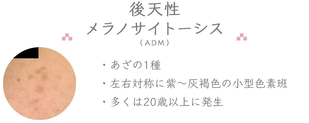 後天性メラノサイトーシス（ADM）：あざの1種／左右対称に紫～灰褐色の小型色素班／多くは20歳以上に発生