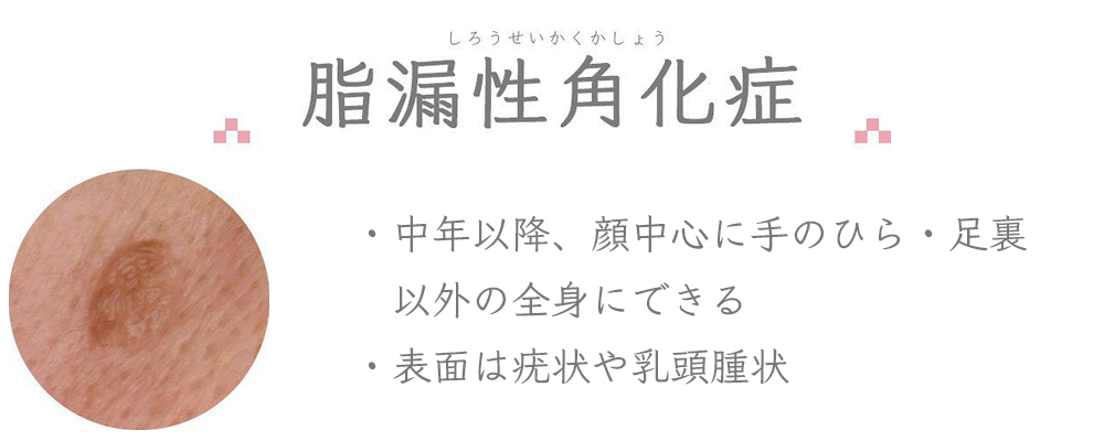 脂漏性角化症：中年以降、顔中心に手のひら・足裏以外の全身にできる／表面は疣状や乳頭腫状