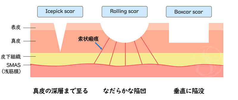 ニキビ痕の種類　萎縮性瘢痕