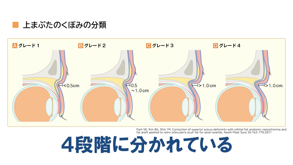 上まぶたのくぼみの分類は4段階に分かれている