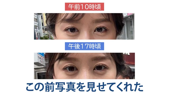 くぼみ目の例