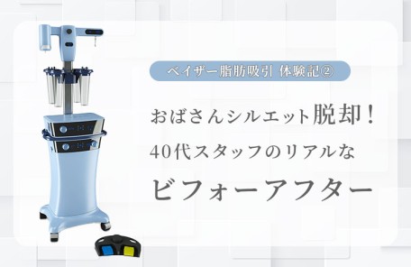 おばさんシルエット脱却！ 40代スタッフのリアルな ビフォーアフター｜ベイザー脂肪吸引体験記②