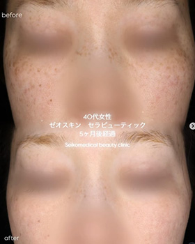 【症例紹介】40代女性ゼオスキン セラピューティック5ヶ月経過