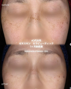 【症例紹介】40代女性ゼオスキン セラピューティック7ヶ月経過
