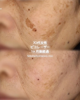 【症例紹介】70代女性　ピコレーザー1ヶ月経過