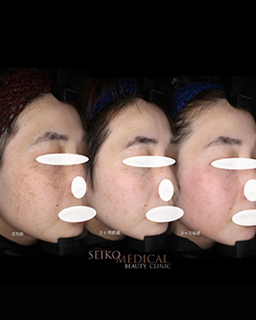 【症例紹介】30代女性ゼオスキン セラピューティック3ヶ月後経過