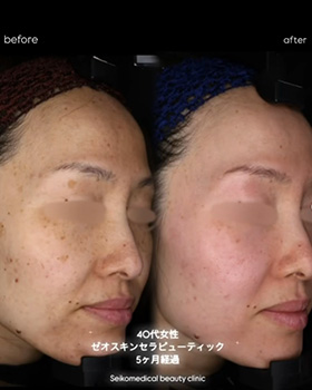 【症例紹介】40代女性ゼオスキン セラピューティック5ヶ月後経過