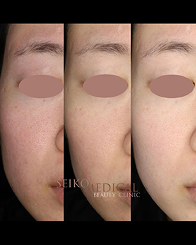 【症例紹介】30代女性　ジェネシス治療