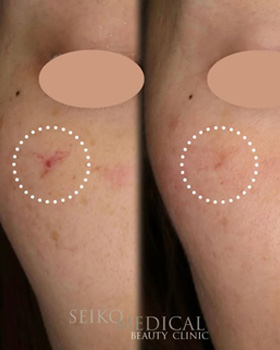 【症例紹介】30代女性　ジェネシス治療（接触照射）