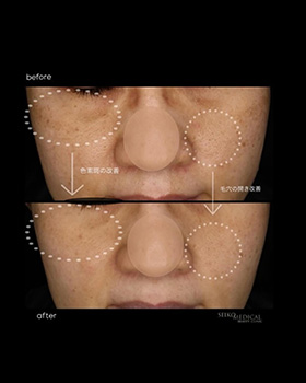 【症例紹介】40代女性　コラーゲンピール・ジェネシス治療・美容内服