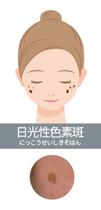 日光性色素班