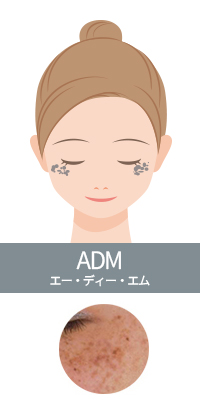 ADM（後天性真皮メラノサイトーシス）