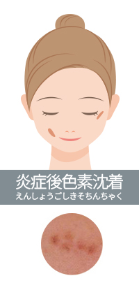 炎症後色素沈着