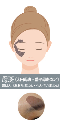 母斑（太田母斑・扁平母斑 など）