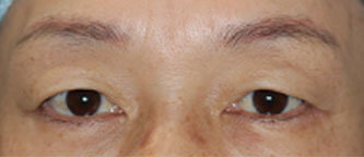 上瞼の治療を２つ行って、劇的に若返った症例