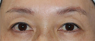 上瞼の治療を２つ行って、劇的に若返った症例