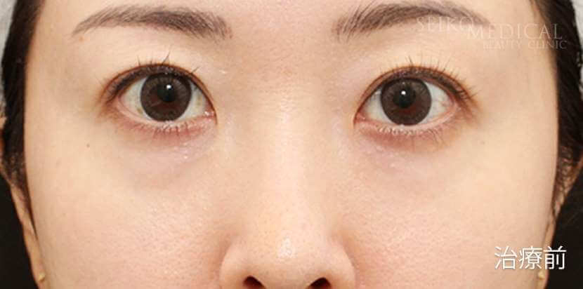 【下眼瞼の脂肪除去、脂肪（マイクロファット、ナノファット）注入】モニターさん症例解説