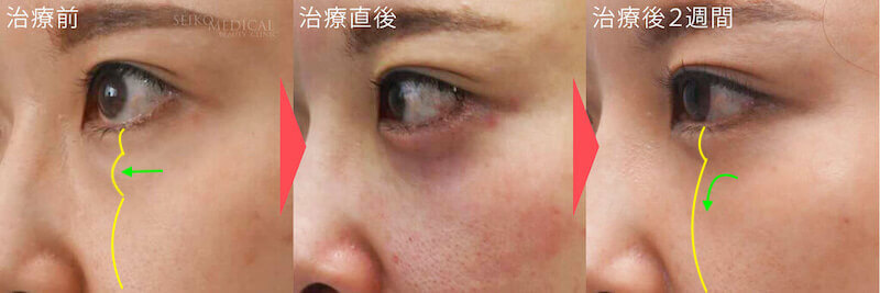 【下眼瞼のクマ、たるみ】裏ハムラ法の術後の腫れの経過写真
