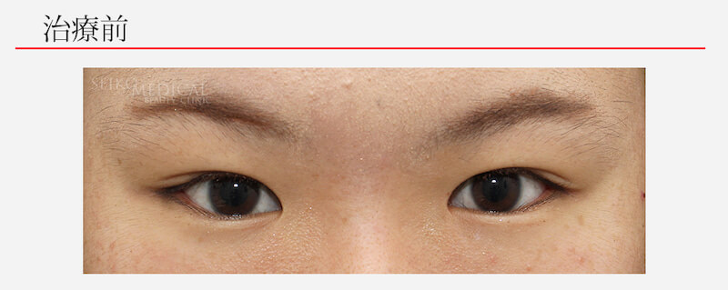 眼瞼下垂の症例解説