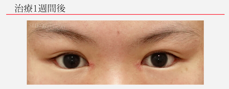 眼瞼下垂、二重、目頭切開、グラマラスライン複合治療の症例解説