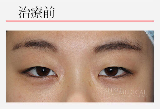 自然に目を大きく見せる治療（切らない眼瞼下垂、二重、上眼瞼脱脂）の症例解説