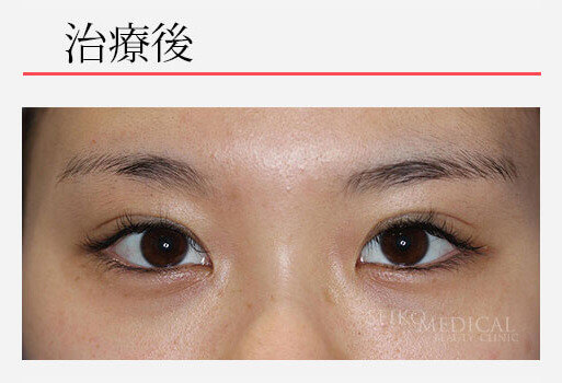 自然に目を大きく見せる治療（切らない眼瞼下垂、二重、上眼瞼脱脂）の症例解説