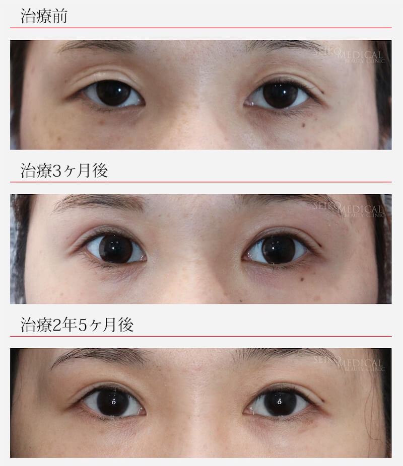 【眼瞼下垂&二重】左右差がある瞼を整えた症例解説。長期経過あり。