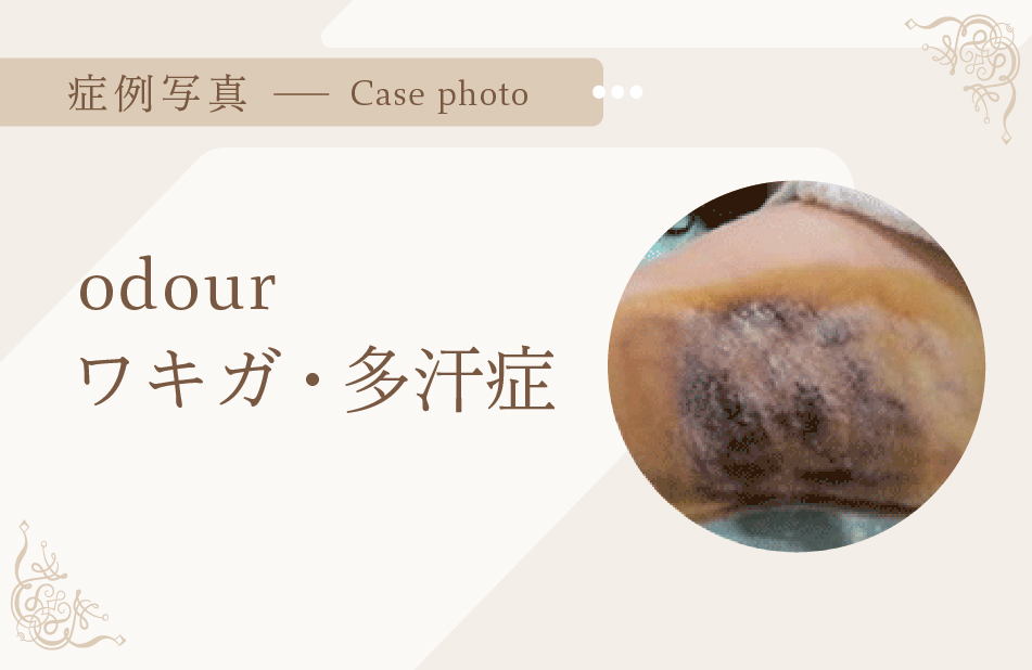 ワキガ・多汗症症例写真